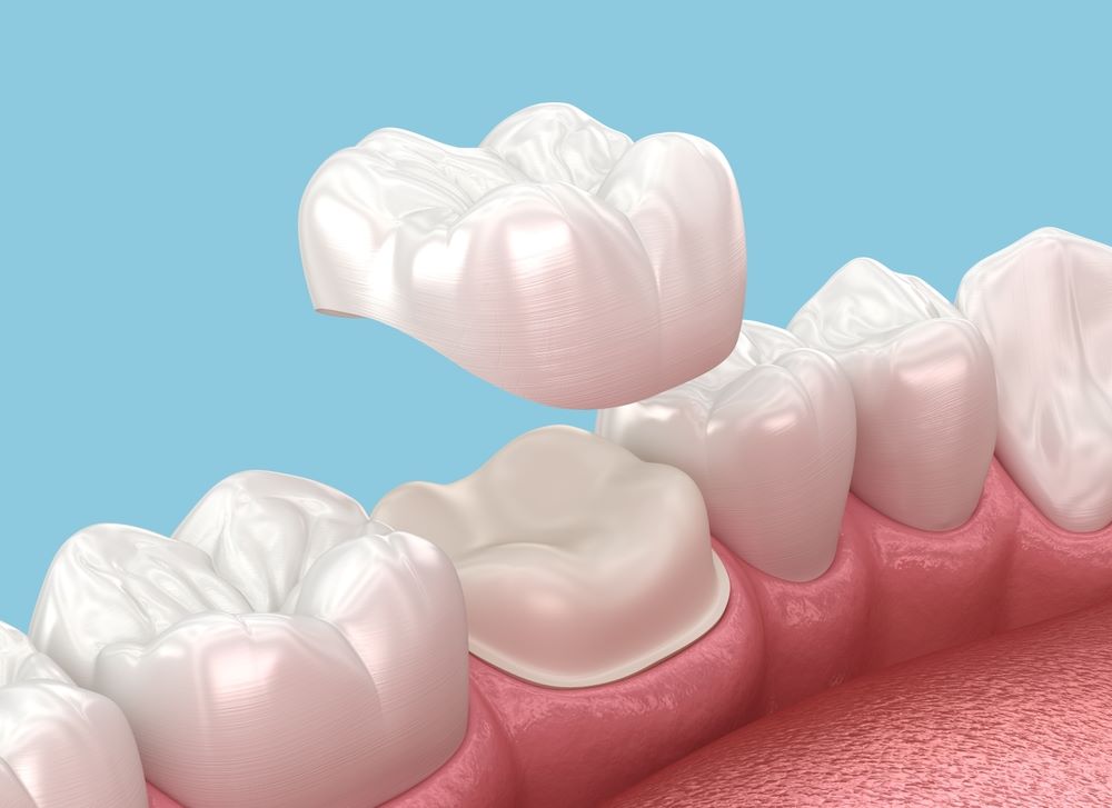 Cosmetic Crowns and Bridges